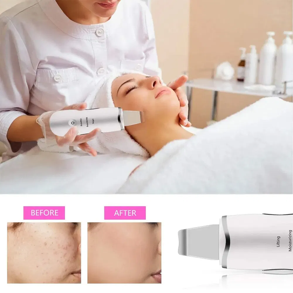 3-in-1 Ultrasonic Facial Spatula For Deep Cleansing, Electric Ultrasonic Skin Scrubber - Image 5